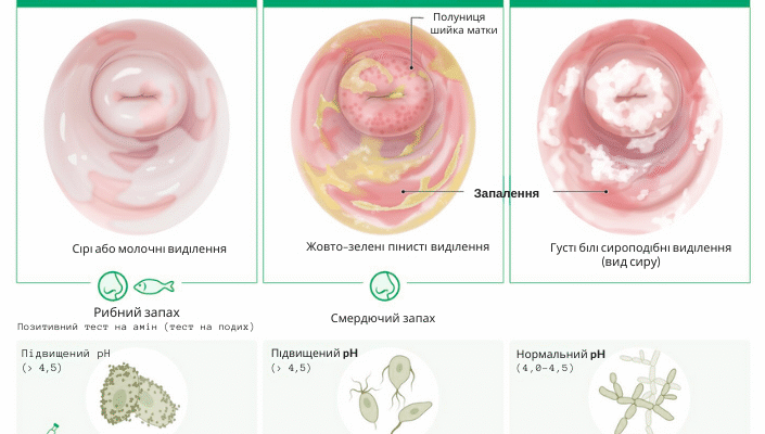 Як ефективно лікувати жовті виділення: поради та рекомендації фахівців
