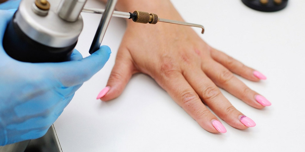 Видалення папілом, бородавок у Тернополі - Profimed