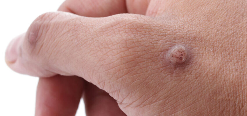 Як ефективно та безпечно вивести бородавки на руках: кращі методи