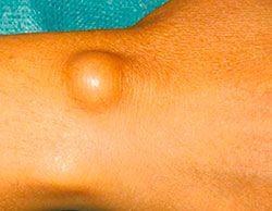 Як ефективно та безпечно зняти запалення атероми: поради та методи