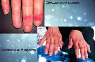 Як ефективно та швидко зняти запалення пальця: практичні поради