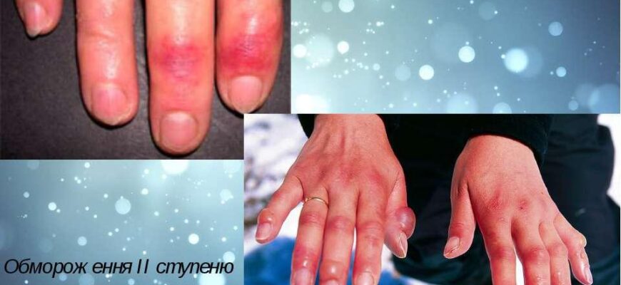 Як ефективно та швидко зняти запалення пальця: практичні поради