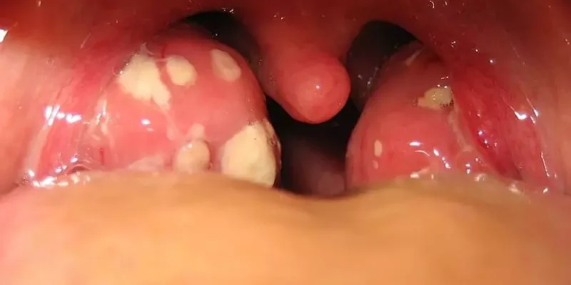 Як ефективно видалити наліт на гландах: поради та методи лікування