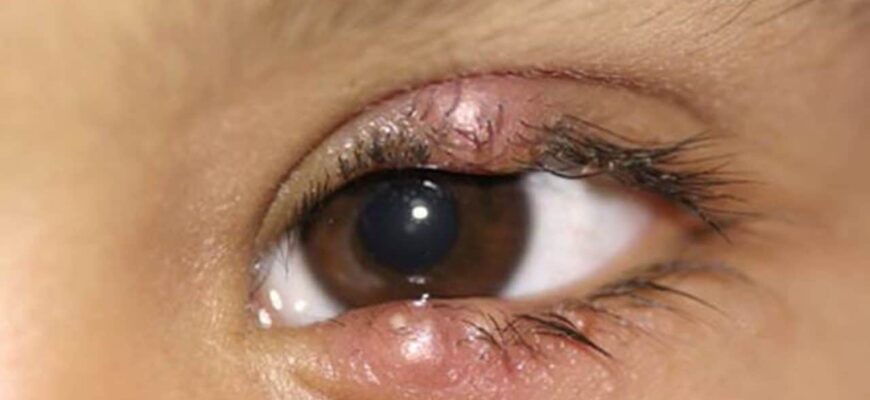 Як ефективно вивести аскариди з організму після лікування: поради та етапи