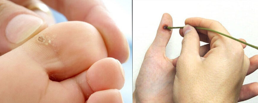 Як ефективно вивести бородавку: дієві методи боротьби та профілактика