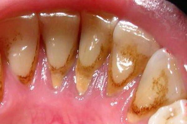 Як ефективно зменшити чутливість зубів в домашніх умовах: поради