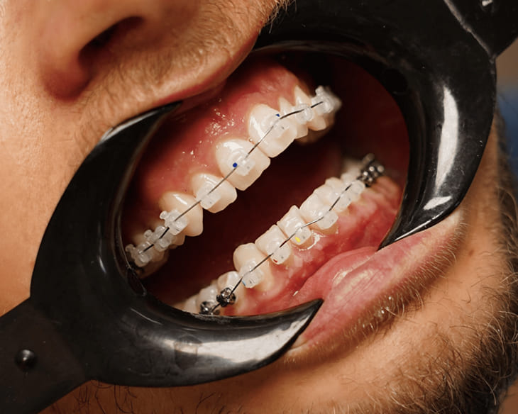 Ξ Як зняти зубний біль в домашніх умовах - DentaDerm