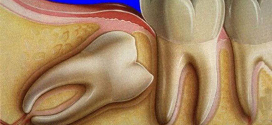 Як ефективно зняти біль зуба мудрості в домашніх умовах?