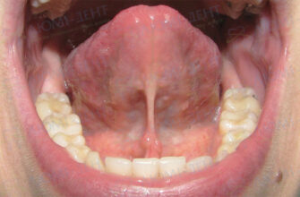 Як ефективно зняти білий наліт з язика у немовлят: практичні поради