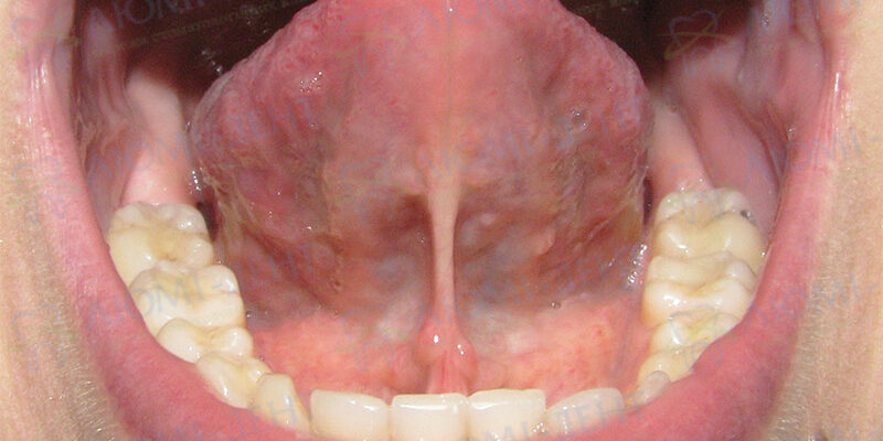 Як ефективно зняти білий наліт з язика у немовлят: практичні поради
