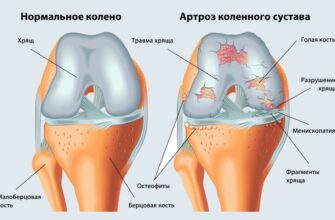 Як ефективно зняти набряк коліна: перевірені методи та поради