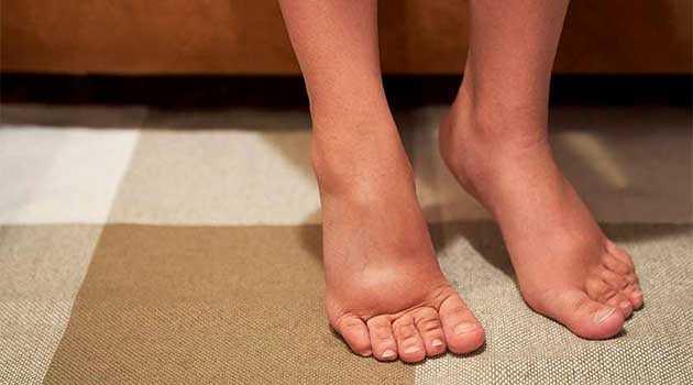 Як зняти набряк ніг швидко: аптечні препарати та домашні методи ...