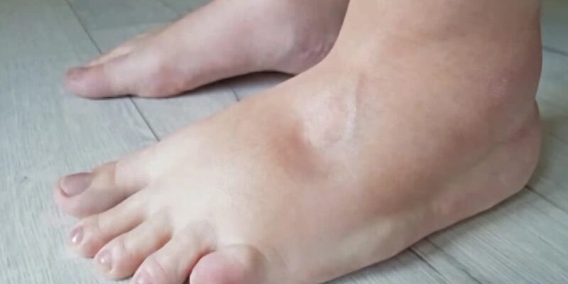 Як ефективно зняти набряк на ногах: корисні поради й засоби