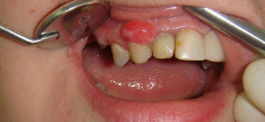 Як ефективно зняти набряк щоки від зубного болю в домашніх умовах