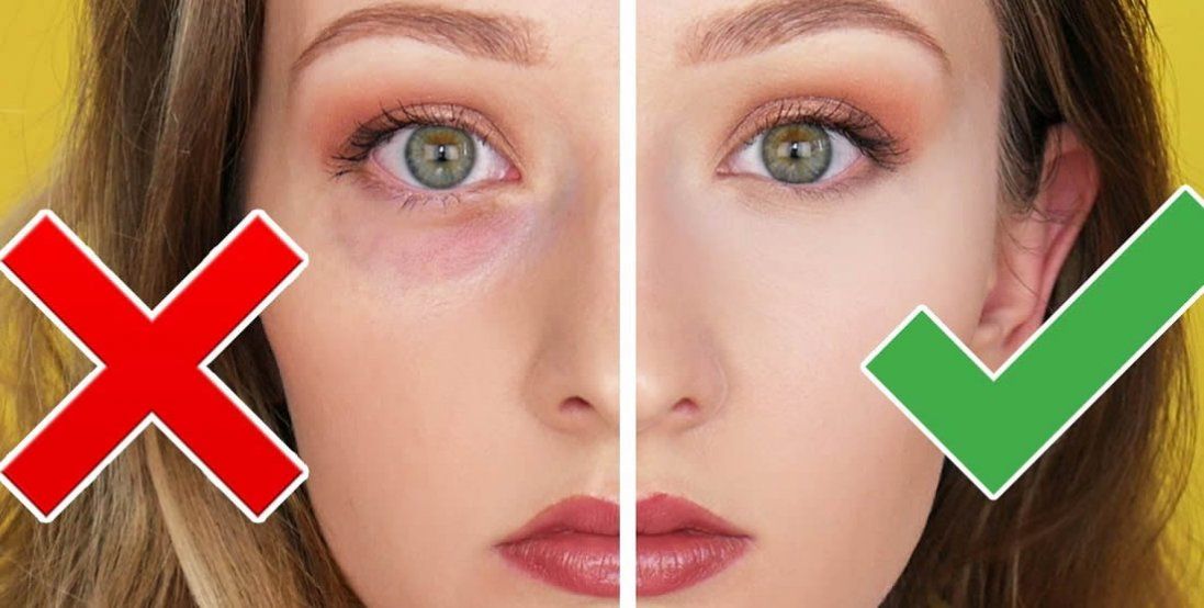 Як позбутися мішків під очима