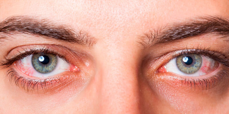 Як ефективно зняти набряки під очима вдома: кращі методи та поради