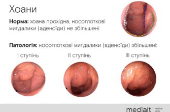Як ефективно зняти запалення аденоїдів: поради та методи лікування