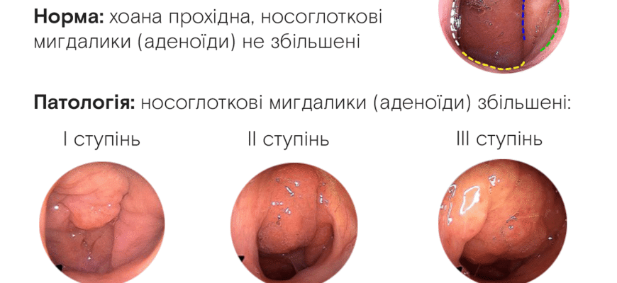 Як ефективно зняти запалення аденоїдів: поради та методи лікування