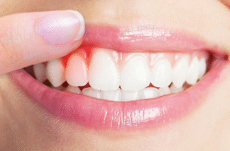 Як ефективно зняти запалення ясен: найкращі методи та засоби