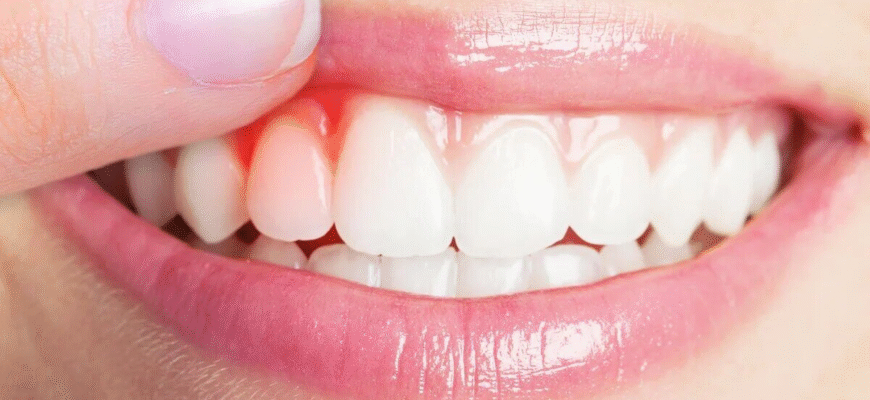 Як ефективно зняти запалення ясен: найкращі методи та засоби