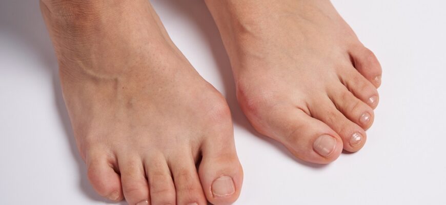 Як ефективно зняти запалення кісточки на нозі: практичні поради
