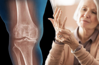 Як ефективно зняти запалення суглобів: поради та методики лікування