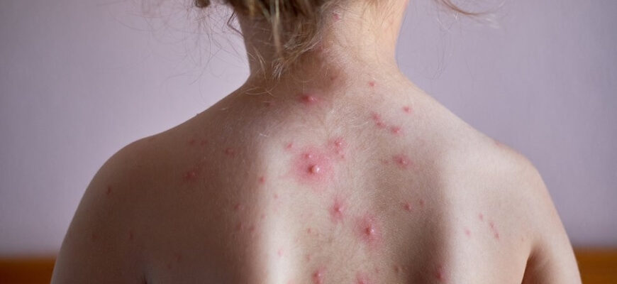 Як ефективно зняти зуд при вітрянці у дітей: рекомендації та поради