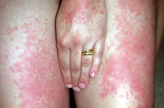 Як лікувати алергію на сонце: ефективні методи та засоби боротьби