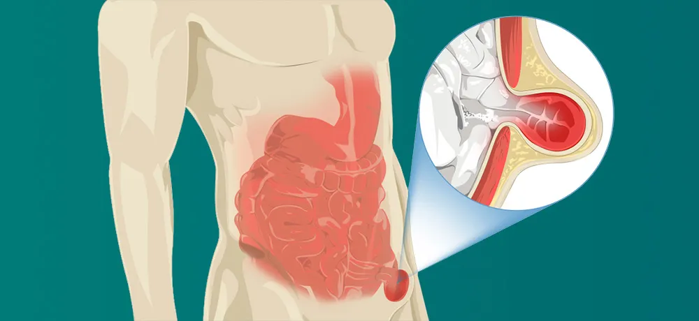 Пахова грижа - одна з найбільш поширених патологій передньої ...