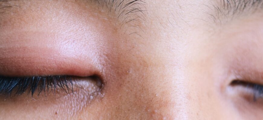 Як швидко і безпечно зняти крововилив в оці в домашніх умовах