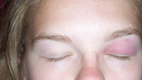 Опух очей — верхню повіку: що робити, як Буран і зняти набряк - У ...