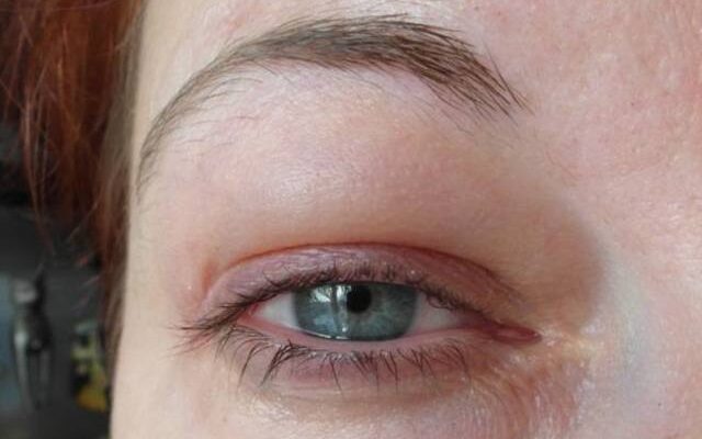 Як швидко і ефективно зняти опухлість очей в домашніх умовах