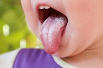 Як швидко та ефективно зняти набряк язика: поради та рекомендації
