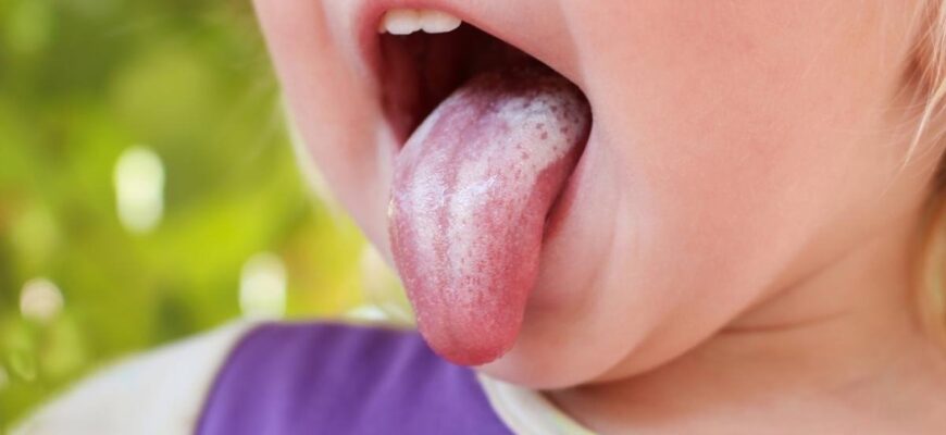 Як швидко та ефективно зняти набряк язика: поради та рекомендації