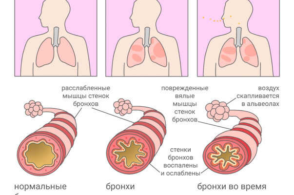 Як швидко та ефективно зняти приступ бронхіальної астми: поради й методи