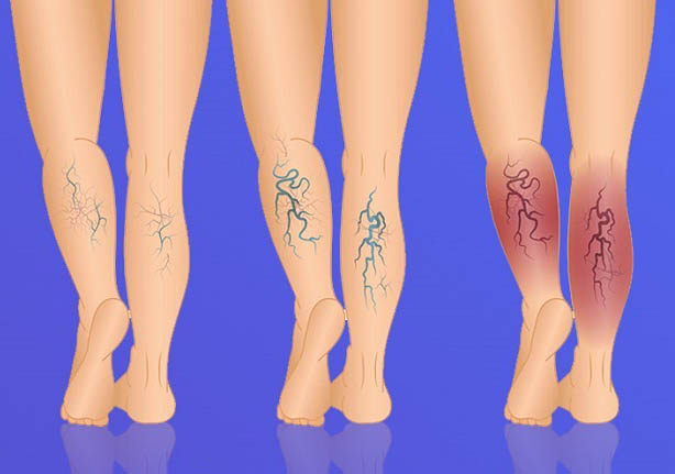 Масаж ніг при варикозі