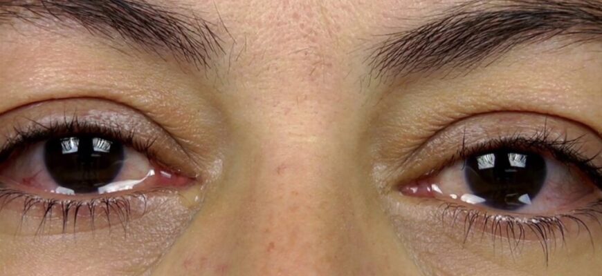 Як швидко зняти набряк очей після сліз: ефективні методи та поради