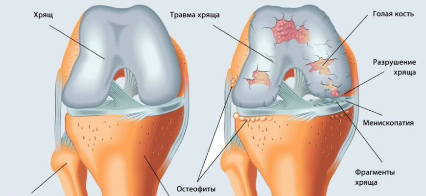 Як швидко зняти запалення коліна: ефективні методи та поради