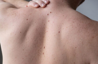 Як виглядає шкіра після видалення родимки: основні етапи загоєння