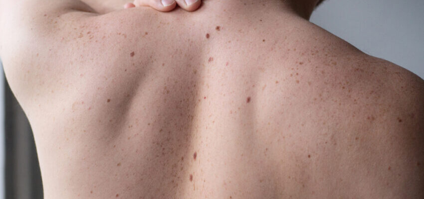 Як виглядає шкіра після видалення родимки: основні етапи загоєння