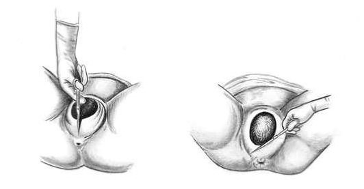 Шви після пологів чим обробляти, коли заживуть і як впоратися з болем