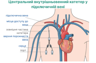 Як запобігти та лікувати запалення вени після встановлення катетера