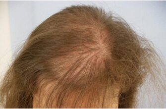 Як зберегти волосся після хіміотерапії: поради та рекомендації