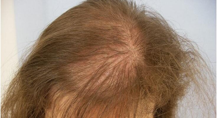 Як зберегти волосся після хіміотерапії: поради та рекомендації