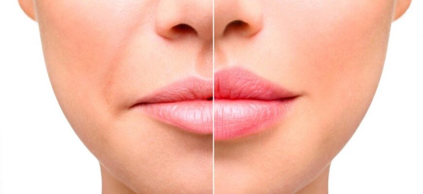 Як збільшити губи: найпопулярніші методи та засоби для об’єму