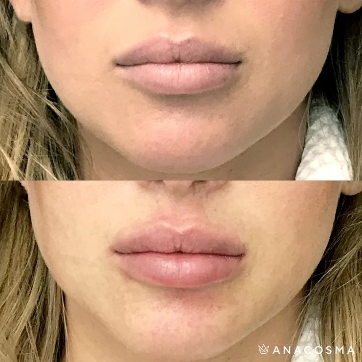 Догляд за губами після збільшення – ANACOSMA Що не можна робити ...