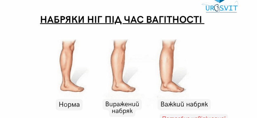 Як зняти набряки ніг при вагітності: поради та досвід з форумів