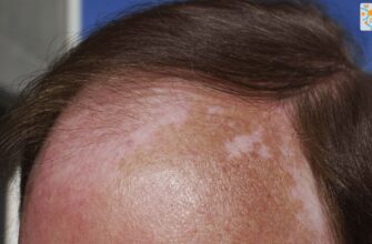 Як зняти свербіж шкіри голови вдома: ефективні домашні засоби