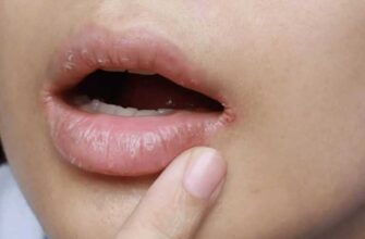 Заїди: ефективні методи лікування та профілактики в домашніх умовах