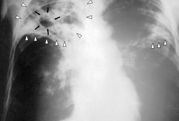 Залишкові зміни після туберкульозу: діагностика та наслідки для здоров’я